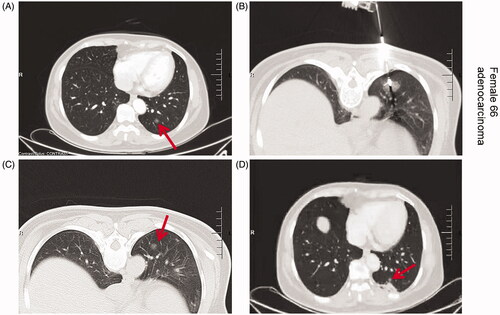 Figure 2. Axial CT images of the 66-year-old women with lung cancer treated with MWA. Upper left: CT prior to MWA treatment shows a single peripheral lesion in the left lung (arrow); Upper right: CT findings during MWA treatment; puncture needle guide electrode reaches the lesion site for MWA; Lower left: CT image 3 months after MWA treatment shows ground-glass changes in the treatment area and decreased density in the central area of the lesion; Lower right: CT image 6 months after MWA treatment shows a reduced ablation area with surrounding signs of inflammation.