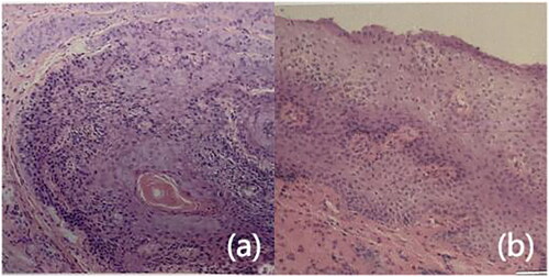 Figure 2. Pathological biopsies before and after treatment. (a) Before treatment, epithelial thickening, with atypical cells, indicating low-grade squamous intraepithelial lesions (hematoxylin and eosin stain, original magnification ×100), (b) after treatment, reduced epithelial thickening compared to pretreatment, without atypical cells (hematoxylin and eosin stain, original magnification ×100).