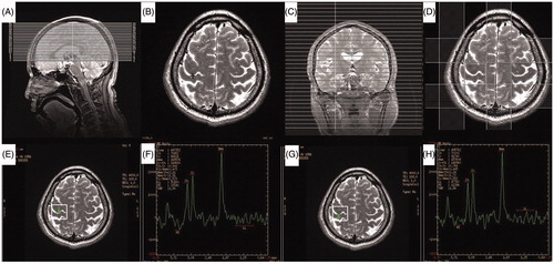 Figure 2. Illustration of the optimized magnetic resonance spectroscopy imaging (MRSI) protocol and resulting spectrum from right hand motor cortex and postcentral gyrus of a normal subject. (A) Saggital view of axial T2-weighted localizer imaging series. (B) Axial T2-weighted image. Black cross indicates the center of the ASSET Calibration sequence. (C) Coronal view of the calibration sequence. (D) Right hand motor cortex and corresponding postcentral gyrus are included in the region of interest. Four outer volume saturation slabs are shown. (E–H) Representative spectrum from right hand motor cortex (E, F) and postcentral gyrus (G, H) of a normal subject.