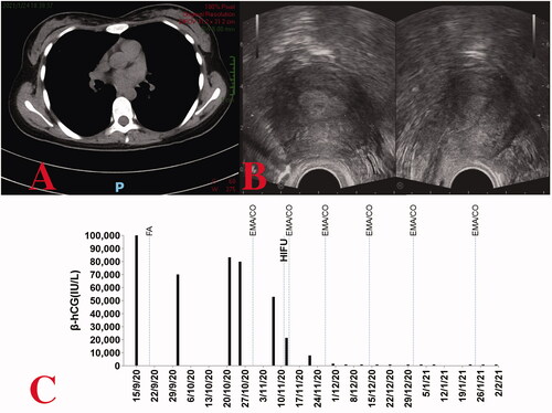 Figure 3. (A) Chest computed tomography revealing regression of the lung tumor following treatment for case one. (B) On transvaginal ultrasound, no obvious abnormalities are observed (coronal view on the left, sagittal view on the right). (C) Serum β-hCG levels throughout the disease duration for case one.