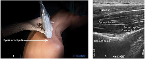 Figure 4 (A) Ultrasound transducer placement for accessing the suprascapular nerve; (B) Ultrasound image of the suprascapular nerve. Source: NYSORA.com. In compliance with ethical and academic standards, we acknowledge NYSORA, Inc. for granting permission to use the images in this article for educational purposes. All rights to these images remain with NYSORA, Inc.
