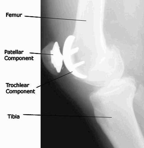 Figure 2. X-ray showing the final position of the implant Citation[10].
