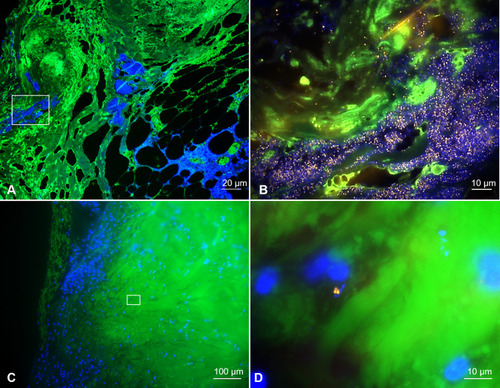 Figure 4 Two patients with different stages of biofilm formation in ex vivo deep sternal wounds ranging from single bacteria to mature biofilms. The upper panel ((A) overview, (B) magnification of the inset) shows extensive bacterial biofilms in patient 8, whereas the lower panel ((C) overview, (D) magnified aspect) features only few single cocci in patient 7. Green – tissue background, blue – nucleic acid stain DAPI staining bacteria and host nuclei, orange – pan-bacterial probe EUB338-Cy3. No signal is seen with the nonsense control probe NONEUB338-Cy5.