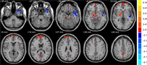 Figure 1 Significantly altered FA values in patients with Stra compared with HCs.