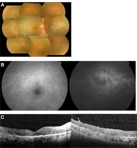 Figure 1 Case 1. Fundus photographs, fluorescein angiograms, and spectral-domain optical coherence tomographic images of the right eye in a 57-year-old man with primary intraocular lymphoma after vitrectomy.