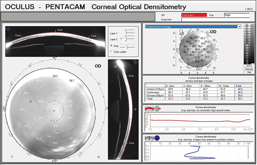 Figure 2. Corneal densitometry quantifies the corneal clouding based on reflectivity pattern. Here, densitometry values are calculated after dividing the cornea into anterior (120 µm), central and posterior (60 µm) divisions, using the Pentacam.