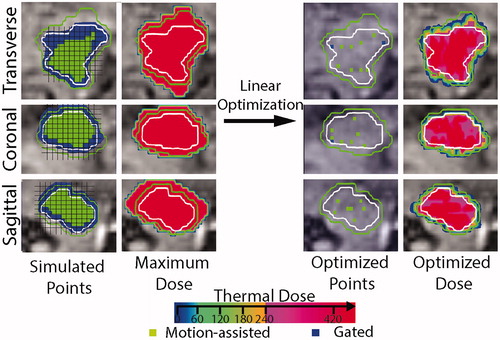 Figure 5. Typical example showcasing the linear optimization step. Single slices in the three orientations are showing, from left to right: all simulated locations (i.e., Cs and Gs), the maximum thermal dose associated with all these locations, the optimized points selected by our algorithm and its associated thermal dose. The contour of the target in the reference phase is represented with a white contour and as an indication a margin contour at 3 mm of the target is indicated in green. Blue and green voxel are locations where gated and motion-assisted sonication can be achieved, respectively.