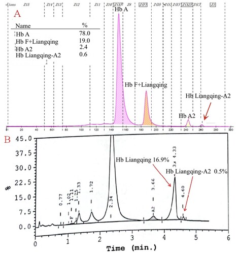Figure 2. Hb analysis of the male in F2 with Hb Liangqing using HPLC and CE. An elevated peak in the F-zone was observed on CE (A), but HPLC revealed an abnormal peak in the S-window (B).