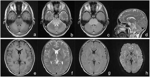 Figure 3. MRI 4 days after ingestion: T1WI (a and e), T2WI (b, d, and f), T2-FLAIR (c and g), and DWI (h) depicting an abnormal medulla oblongata, pons, midbrain, cerebellum, left thalamus, surrounding posterior horn of the lateral ventricle, bilateral brachium pontis, and pedunculus cerebri. DWI: diffusion-weighted imaging; FLAIR: fluid attenuated inversion recovery; MRI: magnetic resonance imaging.