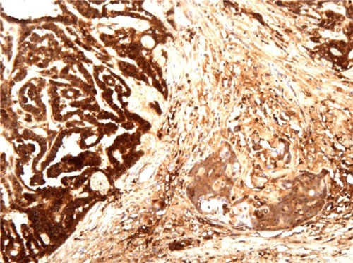 Figure 3 Immunohistochemical staining results for alfa-fetoprotein confirm the existence of two components of endometrial adenocarcinoma and yolk sac tumor.