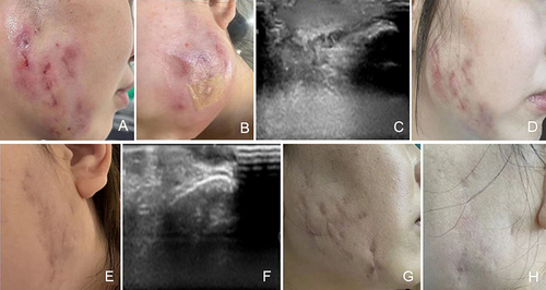 Figure 1 Comparison photos and ultrasound images before and after treatment. (A and B), the cheek capsule with partial rupture and pus at admission; (C), facial mass ultrasound image at admission: several low echo areas in the subcutaneous tissue of bilateral maxillofacial region were detected; and 2 hypoechoic areas were found in the right maxillofacial subcutaneous, extending to the skin with the size of about 2.8cm x 0.7cm and 2.0cm x 0.4cm respectively; (D and E), the cheek 6 months post-treatment: the cheek mass was gradually reduced and the skin ruptures were gradually healed; (F), facial mass ultrasound image 6 months post-treatment: the uneven echo of bilateral maxillofacial subcutaneous tissue, irregular bar hypoechoic and isoecho phase arrangement, about 1.4cm x 0.4cm in the larger area on the right side, and about 1.3cm x 0.6cm in the larger area on the left; (G and H), the cheek 10 months post-treatment: facial symptoms were significantly improved.