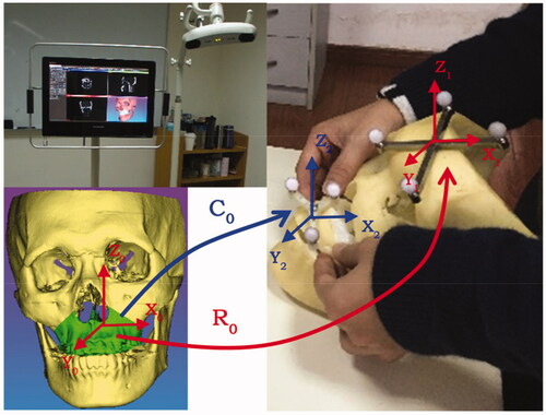 Figure 2. The calibration of the loosed bone graft, and the registration of the whole surgical navigation system.
