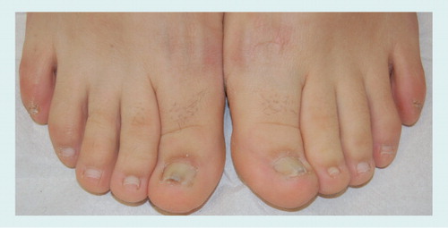 Figure 6. Congenital malalignment of the great toenails with distal onycholysis and subungual hyperkeratosis.Differential diagnosis with distal subungual onychomycosis requires mycology.