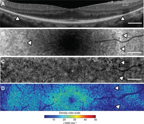 Figure 6 Macular images of OCT (A), fundus autofluorescence (B), adaptive optics (C), and the panoramic cone density map (D) of the right eye in case 2. The OCT image shows the border of the inner segment and outer segment line and the external limiting membrane at the arrowheads (A). Magnifed fundus autofluorescence image of the macula shows part of the high-density fundus autofluorescence ring at the nasal retina [arrowheads in (B)]. The temporal inner border of the ring is indicated by an arrowhead (B). The adaptive optics panoramic image of a 5.9 × 1.1 mm area appears as a blurred region with some dark patchy areas at the nasal side of the high-density fundus autofluorescence ring (arrowheads in C). A panoramic cone density map of the same area as in (C) shows low densities at the nasal ring [arrowheads in (D)]. Bar = 200 um (A-C).