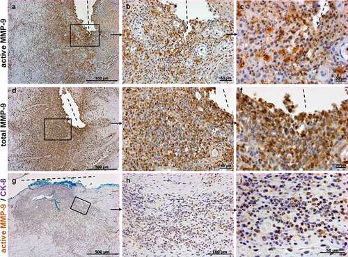 Figure 3. Immunohistochemistry staining showing representative images for active (a-c), total MMP-9 (d-f) and co-staining for active MMP-9 and CK-8 (g-i) in CD perianal or entero-enteric fistulas in non-responder patients under anti-TNF therapy (n = 9). Strong expressions of active and total MMP-9 are detected along and around the fistula. In a different specimen, double positive cells for active MMP-9 and CK-8 are also present along and around the fistula (H, I magnifications of G). The light blue staining is due to the dye used by the surgeons during resection. A and D are consecutive sections with higher magnifications found in B, C and E, F respectively. Dashed line indicates the fistula tract. Small arrows indicate enlargements.