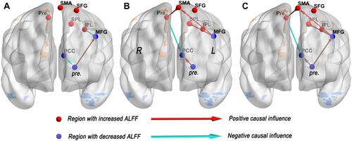 Figure 3 Alteration Effective connectivity between two groups. (A) Effective connectivity from ROI X to ROI Y. (B) Effective connectivity from ROI Y to ROI X. (C) Effective connectivity of the whole brain. Red nodes indicate regions with increased ALFF, and blue nodes suggest regions with decreased ALFF. Red arrows represent hyper-effective connectivity, and green arrows represent hypo-effective connectivity.