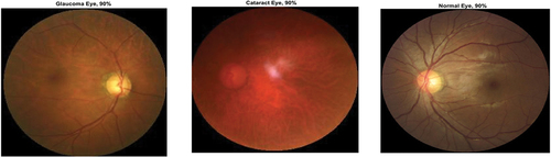 Figure 10. Ocular disease classification using EfficientNet-b0 (batch size-6, optimizer-sgdm) (with augmented image data).