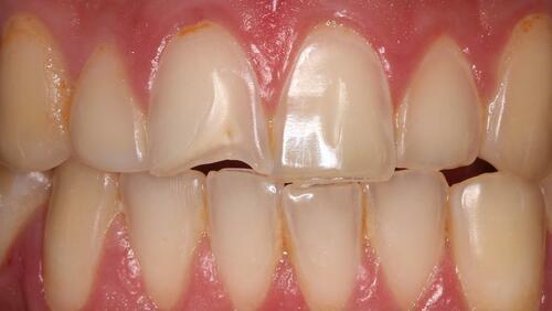 Figure 1 Frontal view of anterior teeth.