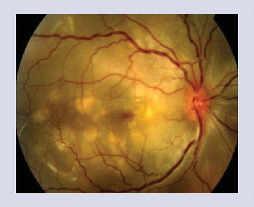 Figure 1. Fundus photograph of the right eye of a patient with acute Vogt–Koyanagi–Harada disease shows deep, round, white-yellowish lesions, variable in size, located in the posterior pole.Note the presence of associated exudative retinal detachment, retinal folds and optic disc hyperemia.