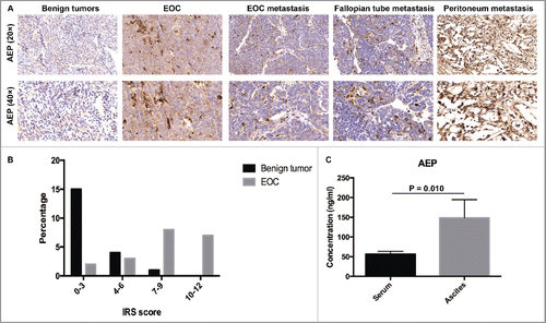 Figure 1. The expression of AEP in EOC patient samples was higher than those in benign ovarian tumor patient samples. (A) AEP was stained in the benign ovarian tumor, EOC and EOC metastasis tissues by immunohistochemistry. (B) Representative IHC staining of AEP protein levels in EOC tissues (n = 20), EOC metastasis (n = 3), fallopian tube metastasis (n = 6), peritoneum metastasis (n = 4) and benign ovarian tumor tissues (n = 20). IRS scoring system was used to evaluate the expression of AEP. (C) The expression of AEP was detected in serum and ascites of EOC patients by Elisa.