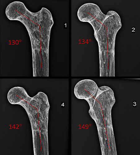 Figure 4 Example with a proximal femur model within a fixed direction X-ray beam demonstrates that rotation of the bone within the beam produces varying perceptions of femoral neck angle. (1) femoral neck angle measured to be 130°, (2) measured to be 134°, (3) measured to be 149°, and (4) measured to be 142°.