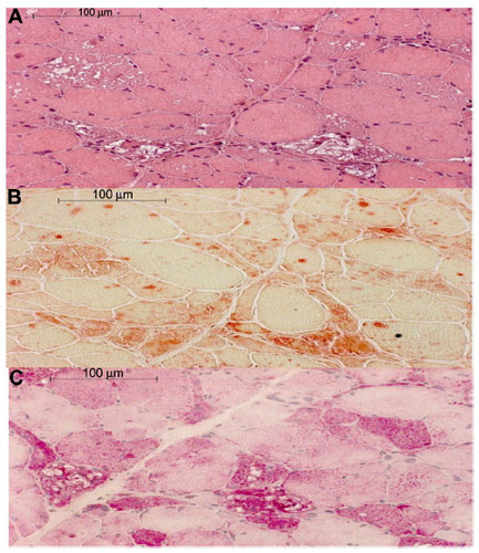 Figure 1 Histological findings in Pompe disease.