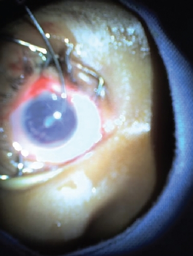 Figure 2 Eye with secondary cataract after removing worm.