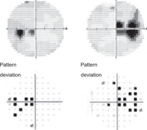 Figure 1 Automated visual field testing shows bilateral cecocentral visual defects.