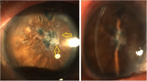 Figure 3 UT-DSAEK performed 3 months after descemetorhexis for removal of anterior synechiae allowed the restoration of corneal clarity. Note the fibrotic and wrinkled membrane at the level of the pupil consisting of detached Descemet membrane and iridocorneal tissue (yellow arrows).