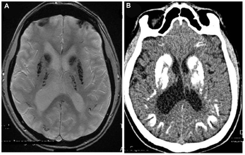 Figure 1 (A) Magnetic resonance axial section T2* GRE sequence with extensive brain calcification. (B) Computed tomography scan axial section with basal ganglia calcification.