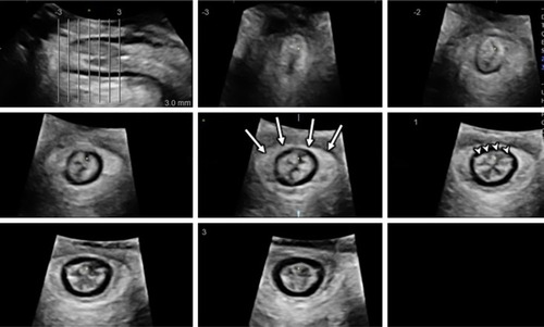 Figure 5 Three-dimensional transperineal tomographic ultrasound images of anal sphincter.
