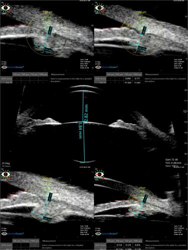 Figure 2 Collage of images of sulcus-to-sulcus axial scan and 4 quadrant scans at 12, 3, 6, and 9 clock hours of a case in the PI group.