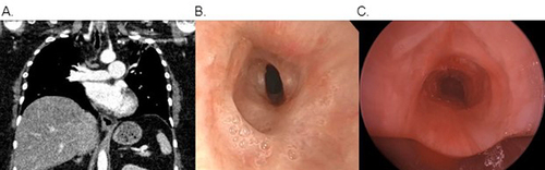 Figure 5 Grade 3, oval, corkscrew-type stenosis which extended 2 tracheal rings seen on CT chest (A) and pre-dilation bronchoscopy (B). Post-dilation bronchoscopy reveals airway patency (C).