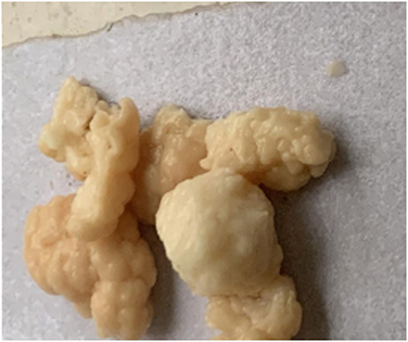 Figure 3 A portion of yellowish-white nodular infection was surgically removed from the right renal pelvis.