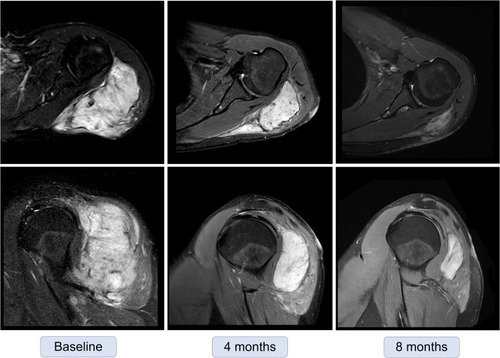 Figure 2 A 27-year-old patient with the partial disease after eight months of anlotinib treatment.