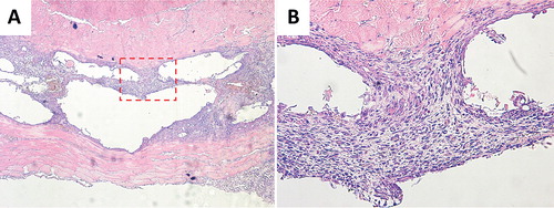 Figure 4. Histology images of hydroxyapatite granules in muscle pouch (A 4×; B 20×). The tissue between the two muscle layers consisted of granuloma and empty cavities from the hydroxyapatite granules, which had been dissolved during decalcification. No cartilage or bone could be seen bordering the cavities where the granules had been, or elsewhere.