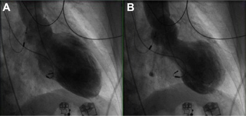 Figure 1 Midventricular variant of stress-induced cardiomyopathy. End-diastolic (A) and end-systolic (B) images of the left ventricle, obtained during ventriculography, in a patient with chest pain.