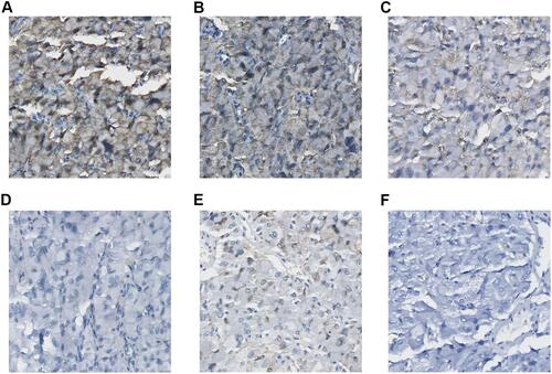 Figure 2 Immunohistochemical staining of the three cases. Immunohistochemistry. Brown staining indicates the positive result (X400). (A) Positive for synaptophysin. (B) Positive for chromogranin. (C) Positive for Vim. (D) Negative for Ki67. (E) The sustentacular cells are stained positive for S100 protein. (F) Negative for cytokeratin.