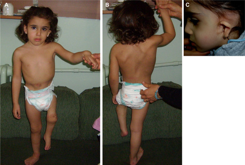 Figure 1 (A) Front view of the patient, showing facial asymmetry, pes equinovarus on the left side, a 90 degree flexion contracture of the left knee, and marked shortness of the lower limb. Hypoplasia of the muscles and subcutaneous fat in the stylopod with overt reduction of the limb circumference were also noted. (B) Back view of the patient, showing scoliosis and tethered cord. (C) A low-set left ear and atretic pinna (left microtia).