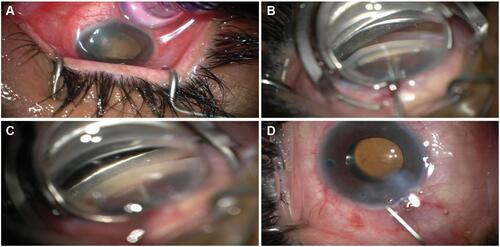 Figure 2 Intra-operative pictures of the surgical procedures. (A) MicroPulse transscleral laser therapy using the Cyclo G6 laser system. (B) Kahook Dual Blade (KDB) assisted goniosynechialysis. (C) KDB-assisted excisional goniotomy. (D) Removal of ophthalmic viscoelastic device and blood reflux with irrigation/aspiration.