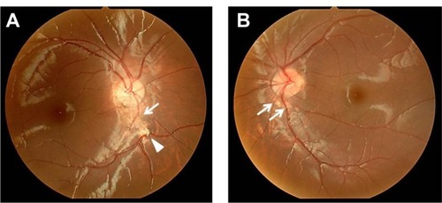 Figure 3 Case 1: funduscopy findings.