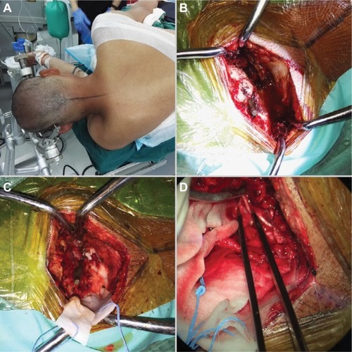 Figure 3 Intraoperative images showing the iron rod lodged in the posterior skull and in the brain tissues (A–D).