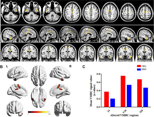 Figure 3 Spontaneous brain activity in patients with diabetes optic neuropathy (DONs) versus healthy controls (HCs). (A and B) Significant activity differences were observed in the right temporal inferior area, left temporal inferior area, right cingulum mid area, left cingulum mid area, right supp motor area, and left supp motor area. Red or yellow denote higher voxel mirrored homotopic connectivity(VMHC) values. P<0.01 for multiple comparisons using Gaussian random field theory (z>2.3; P<0.01; cluster >40 voxels, AlphaSim corrected). (C) Mean values of altered VMHC values between the two groups.