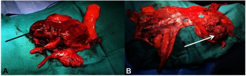 Figure 5 Operating views of thymic surgery: (A) enlarged thymectomy for B2 thymoma, the black arrow indicates the tumor developed in the left side of the thymus with mediastinal pleural involvement. (B) Right pleura after cytoreductive pleural surgery during ITCH procedure. The white arrow indicates pleural node of a A thymoma R0 resected two years before.