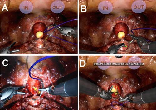 Figure 1 Guided urethrovesical anastomosis on RobotiX Mentor. The initial target point for guided sewing is marked with yellow and with an arrow indicating the direction (A). A green target point designates accurate needle puncture (B), whereas a red target point designates inaccurate needle puncture (C). The guided task provides step-by-step instructions (D).