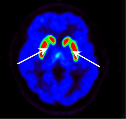 Figure 5 PET-CT image of VMAT2 distribution in a normal person. Two white arrows show the normal dopamine level of bilateral putamen.