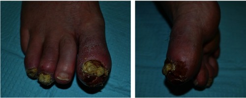 Figure 1 Right foot of a 64-year-old patient who first presented with asymmetric dactylitis characterized by erythema and tenderness of the first, third, and fourth distal interphalangeal joints with associated nail deformities. Written informed consent was obtained to take and publish the photographs above. Patient reported a history of possible osteomyelitis diagnosed by primary care provider, but this diagnosis was not supported by imaging, and symptoms progressed despite antibiotic treatment. Initially treated with topical steroids, resulting in preliminary improvement of skin changes. Approximately, 6 months after skin changes began, patient was found to have the findings documented in these figures. The clinical history and presentation of pustules, scale, erythema, and nail dystrophy of the first, third, and fourth digits were consistent with chronic Acrodermatitis continua of Hallopeau.