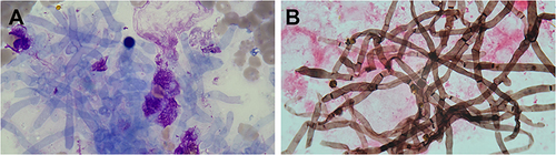 Figure 2 Histology analysis of the lung sections after the wedge resection surgery. Septate hyphae were observed by Wright-Giemsa (A) and hexamine-silver (B) staining of lung sections, indicating C. cinerea infection.