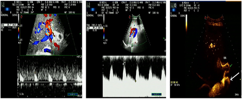 Figure 2 Left and middle: color Doppler ultrasound images. Left: the blood flow velocity was 16.7 cm/s on the hepatic artery spectrum; middle: the splenic artery velocity was 208.2 cm/s on the splenic artery spectrum; right: white arrows showed the large spleen artery and green arrows showed the fine hepatic artery.