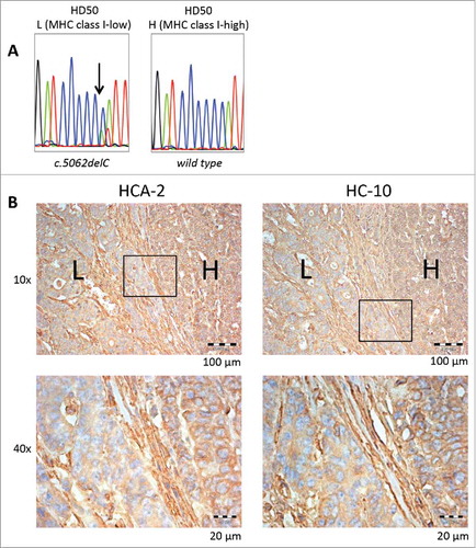 Figure 5. Regional NLRC5 mutation and corresponding HLA class I antigen expression. NLRC5 sequencing results of microdissected HLA class I low (“L”) and high (“H”) regions are shown in A, and IHC staining of HD50 tumor samples with HCA-2 and HC-10 antibody in different magnifications is shown in B. Regions with high HLA class I antigen expression (H) showed the wild type C6 repeat of NLRC5, whereas the NLRC5c.5062del frameshift mutation was restricted to the area with reduced HLA class I antigen expression.